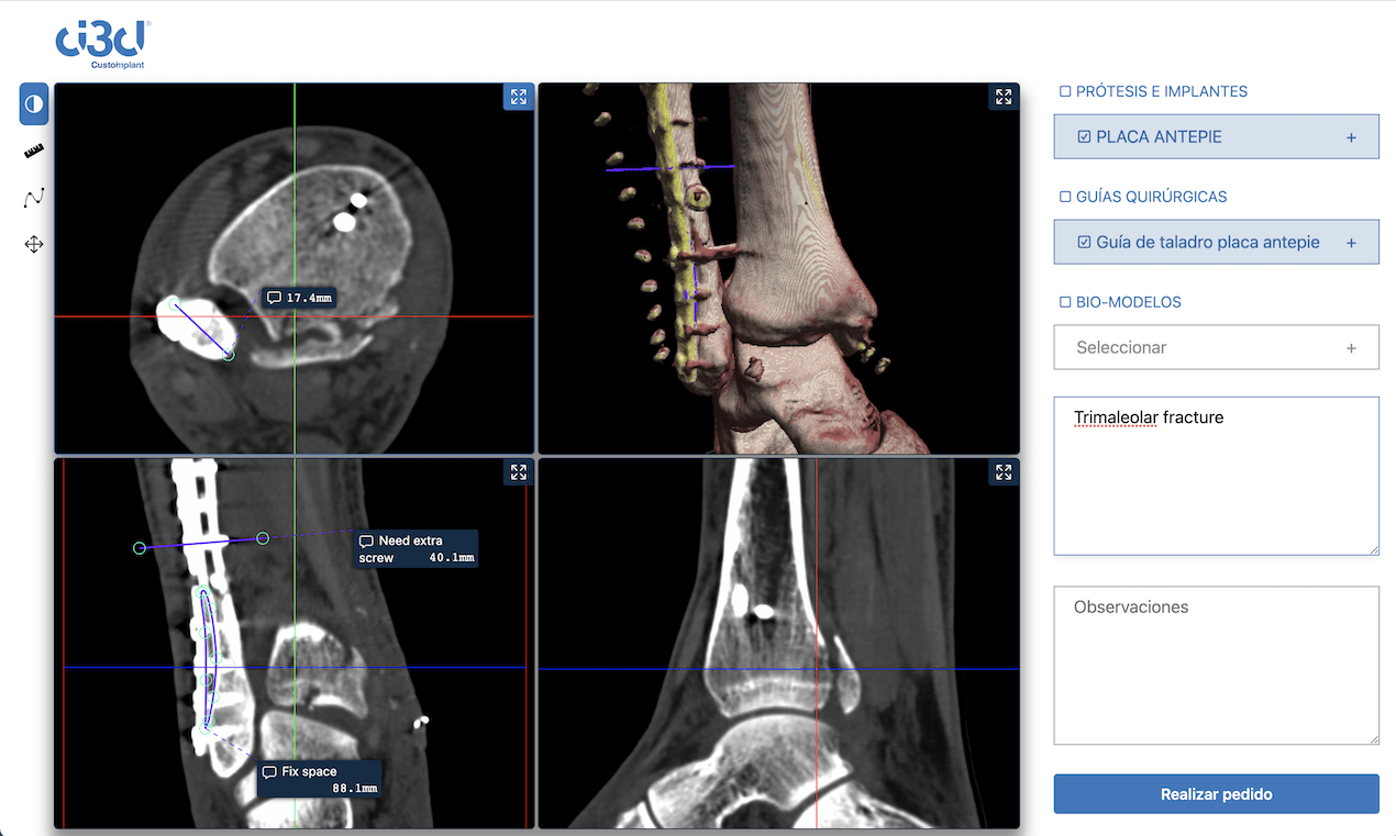 A custom-implant ordering tool built on the set.health SDK, showing a fractured ankle with surgical plates and screws planned over the CT scan, alongside controls to order implants, surgical guides, and 3D-printed bio-models