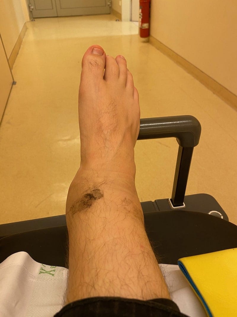 Picture of my ankle