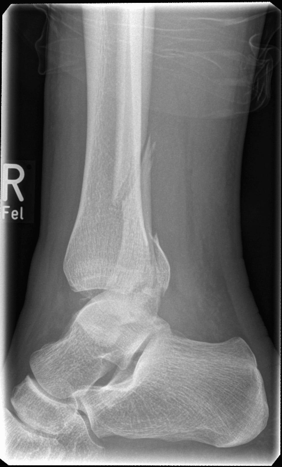 Sagittal radiography of my ankle