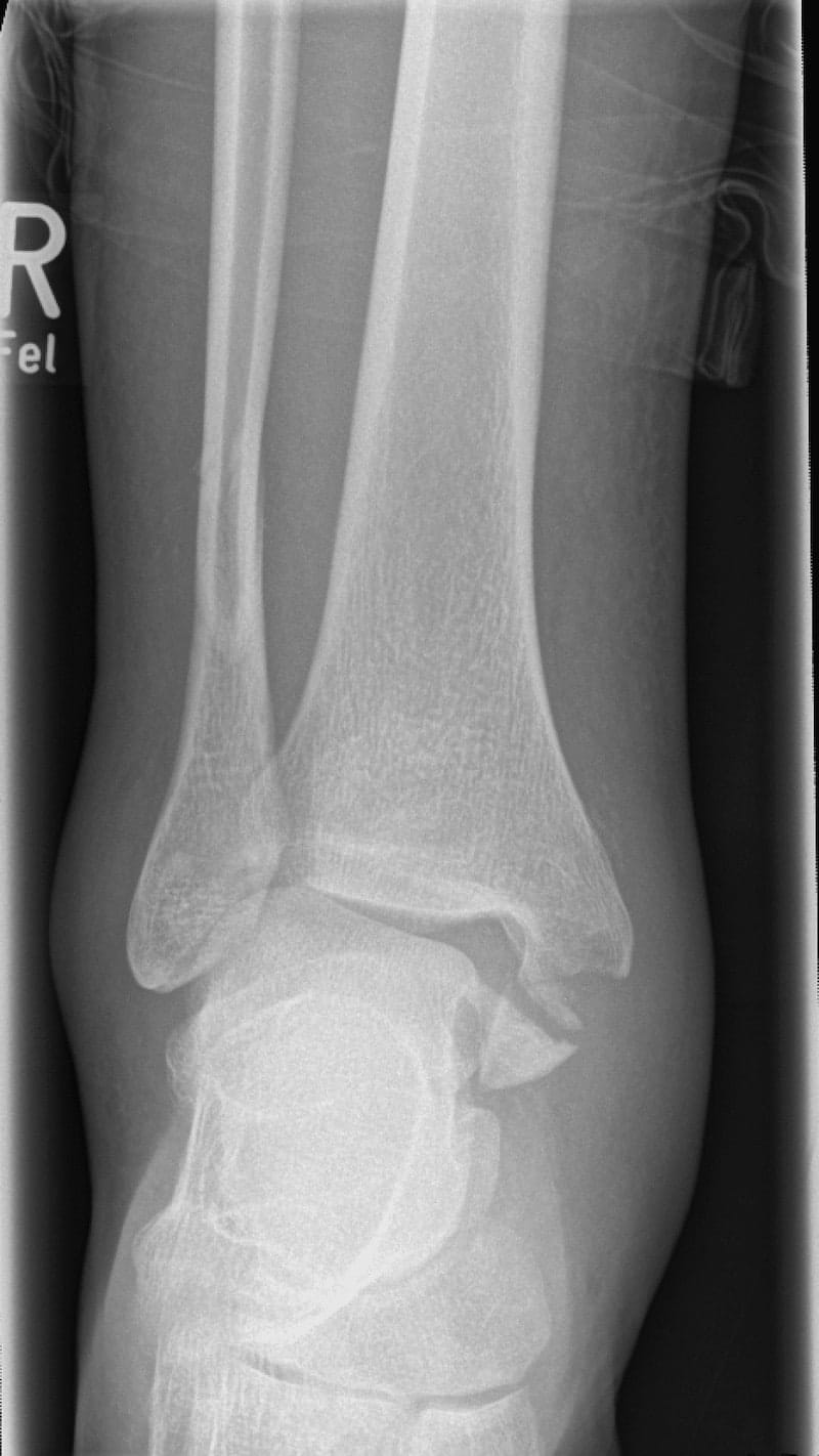 Coronal radiography of my ankle