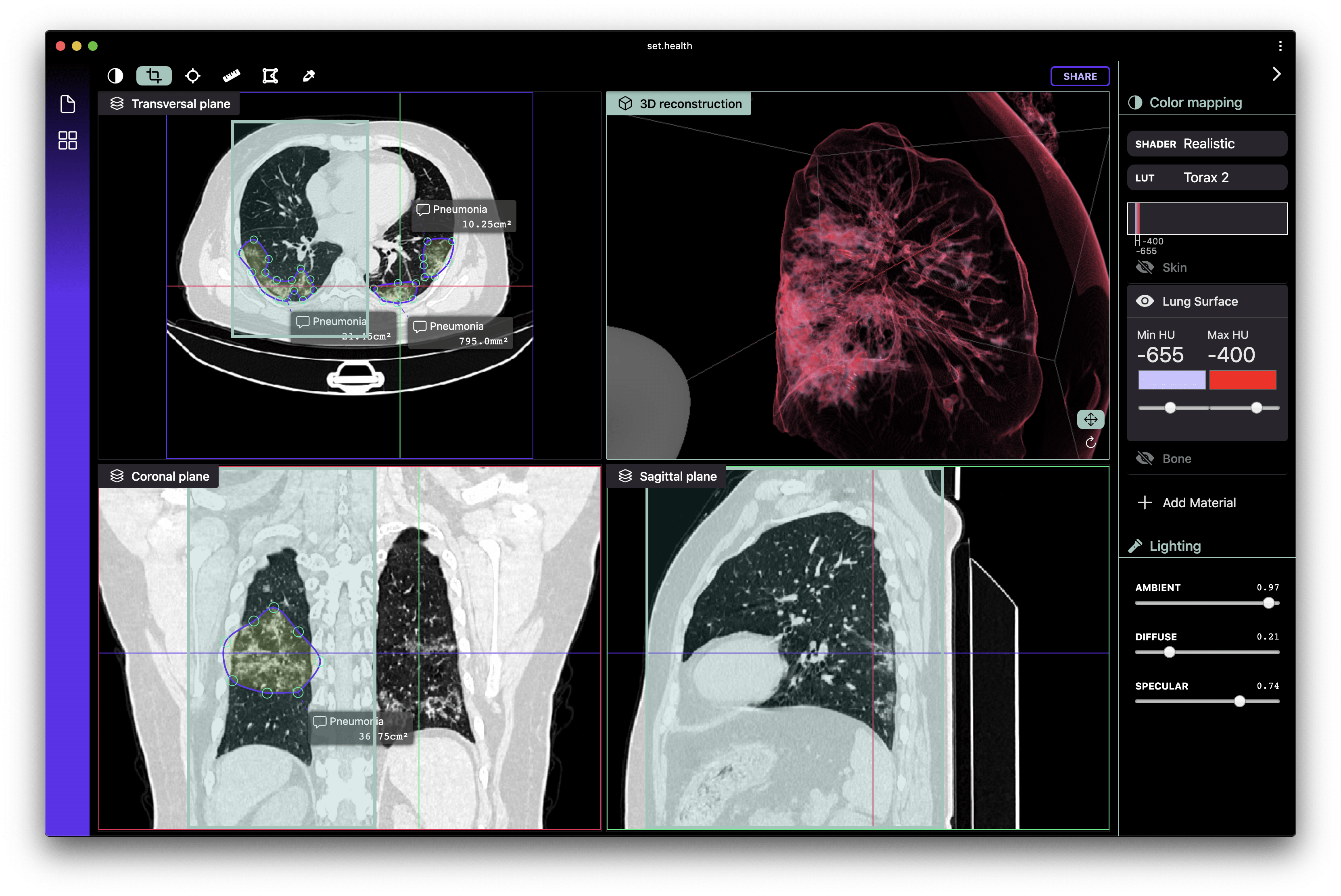 Screenshot of a COVID19 case, showing pneumonia